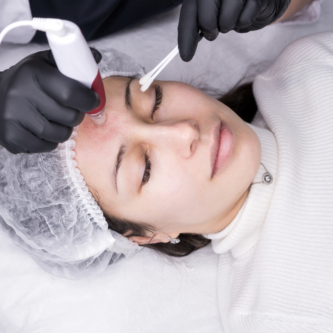 Facial Vascular Lesions Removal