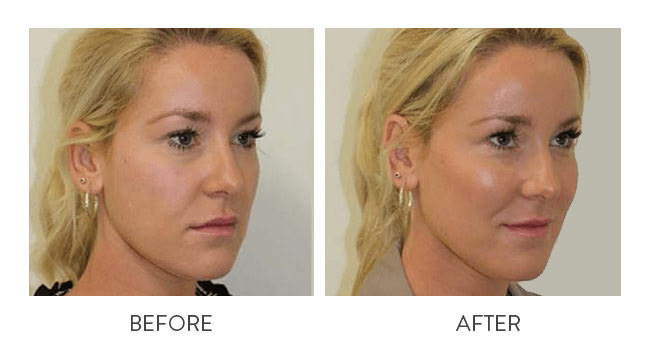 Derma Fillers Before and After