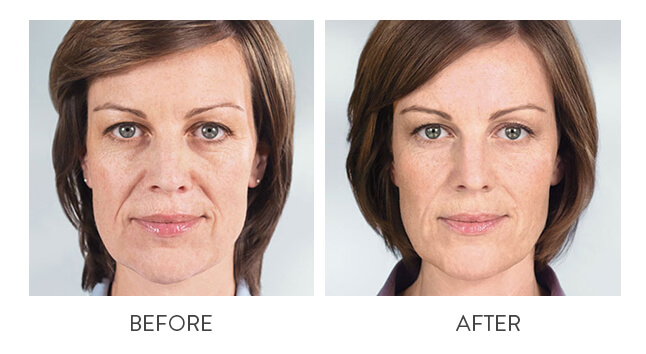 Sculptra Before and After