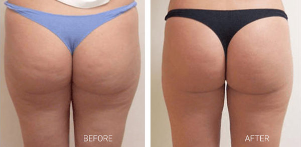 Velashape Before and After