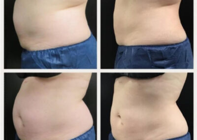 Before After Coolsculpting