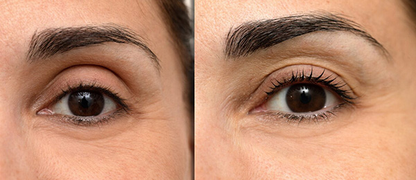 Before and after Lashes and brows treatment at Bare Medical Spa and Laser Center