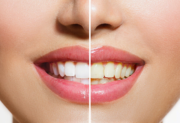 Benefits of beaming white teeth whitening at Bare Medical Spa and Laser Center