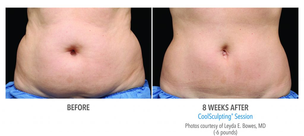 CoolSculpting Before and After Results