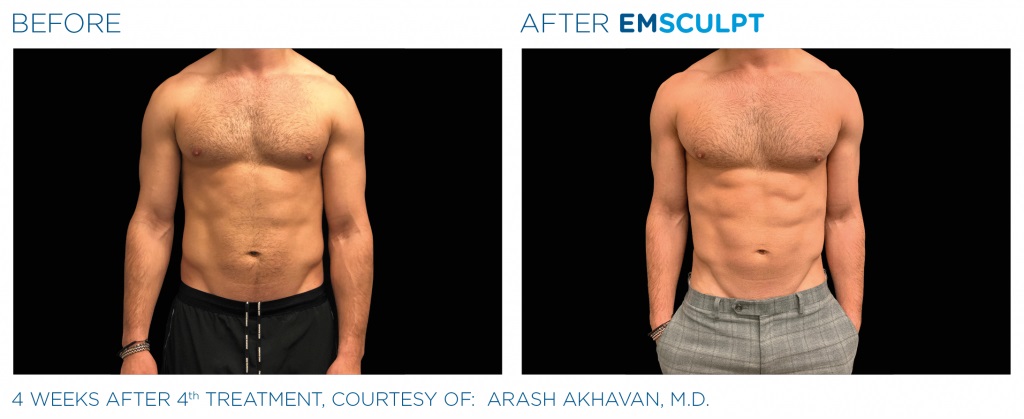 Emsculpt Before and After Results