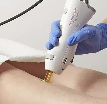 Laser hair removal treatment at Bare Medical Spa