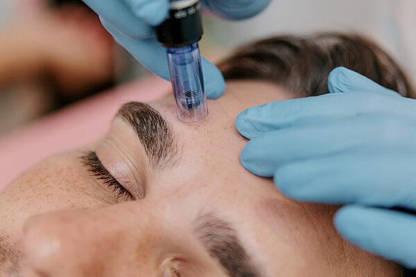 Man undergoing microneedling at Bare Medical Spa and Laser Center