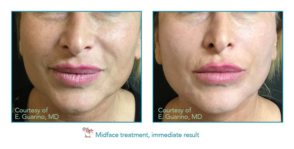 Midface Treatment Before and After