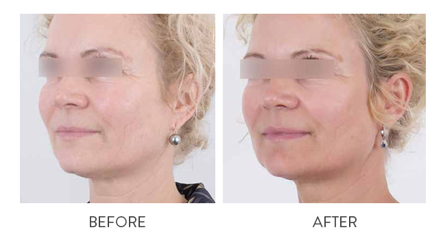 Laser skin resurfacing Before and After
