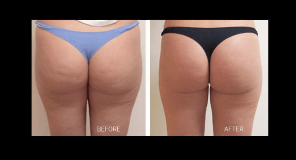VelaShape Before and After Results
