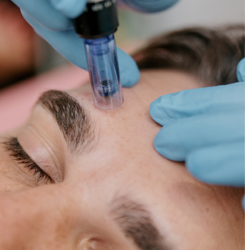 Client undergoing Microneedling at Bare MedSpa and Laser Center